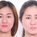 Mở rộng góc mắt