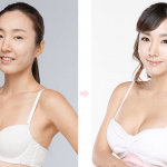 Nâng ngực thẩm mỹ