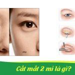 cat mat 2 mi la gi, cắt mắt 2 mí là gì?