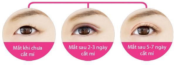 Sự thay đổi của mí mắt sau khi cắt mắt 2 mí dr. thành mori