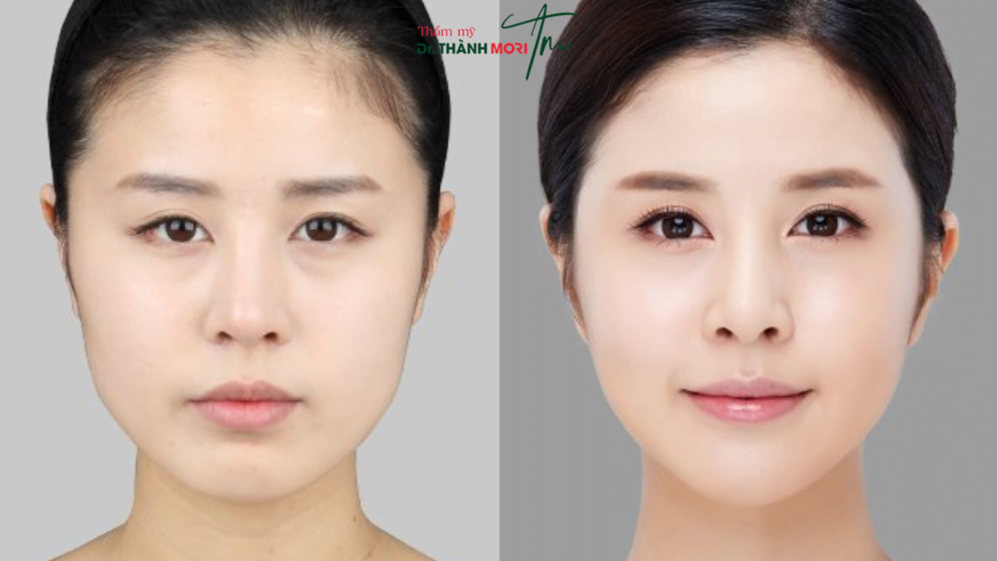 filler và botox làm căng bóng da tức thì